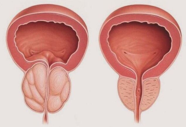 gezonde en ontstoken prostaat met prostatitis