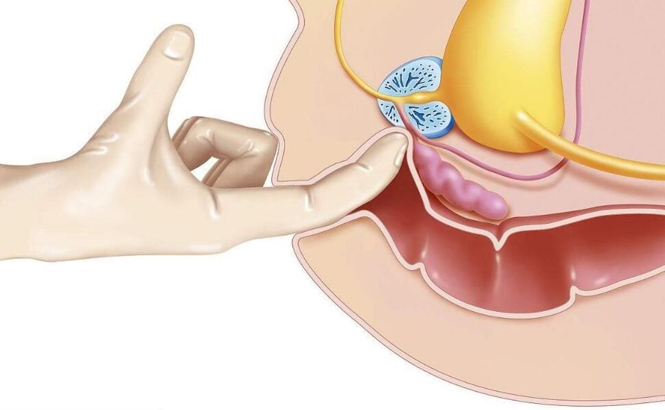 prostaatmassage voor de behandeling van prostatitis